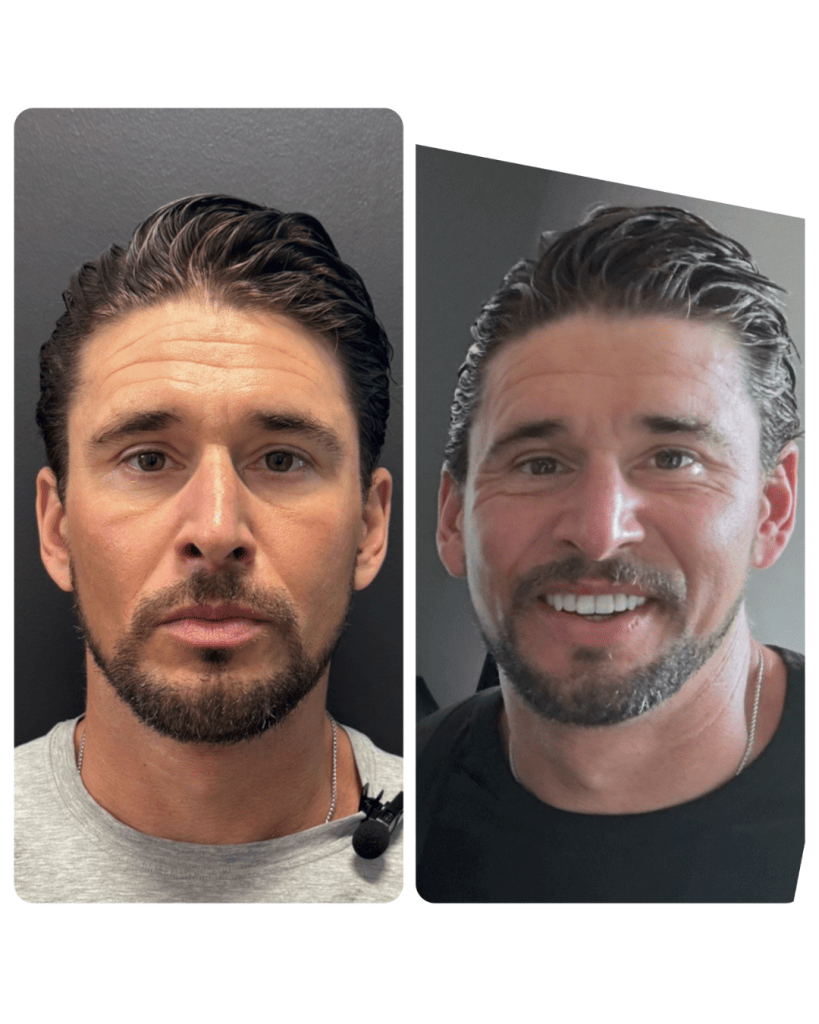 Ben Greenfield Before and after from PRP Microneedling