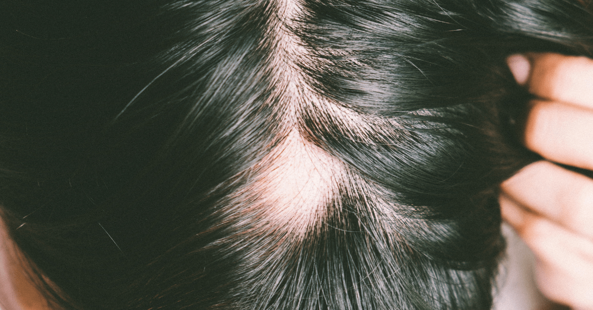 4 At Austin Regenerative Therapy we do a blood analysis to identify the root cause of hair loss.